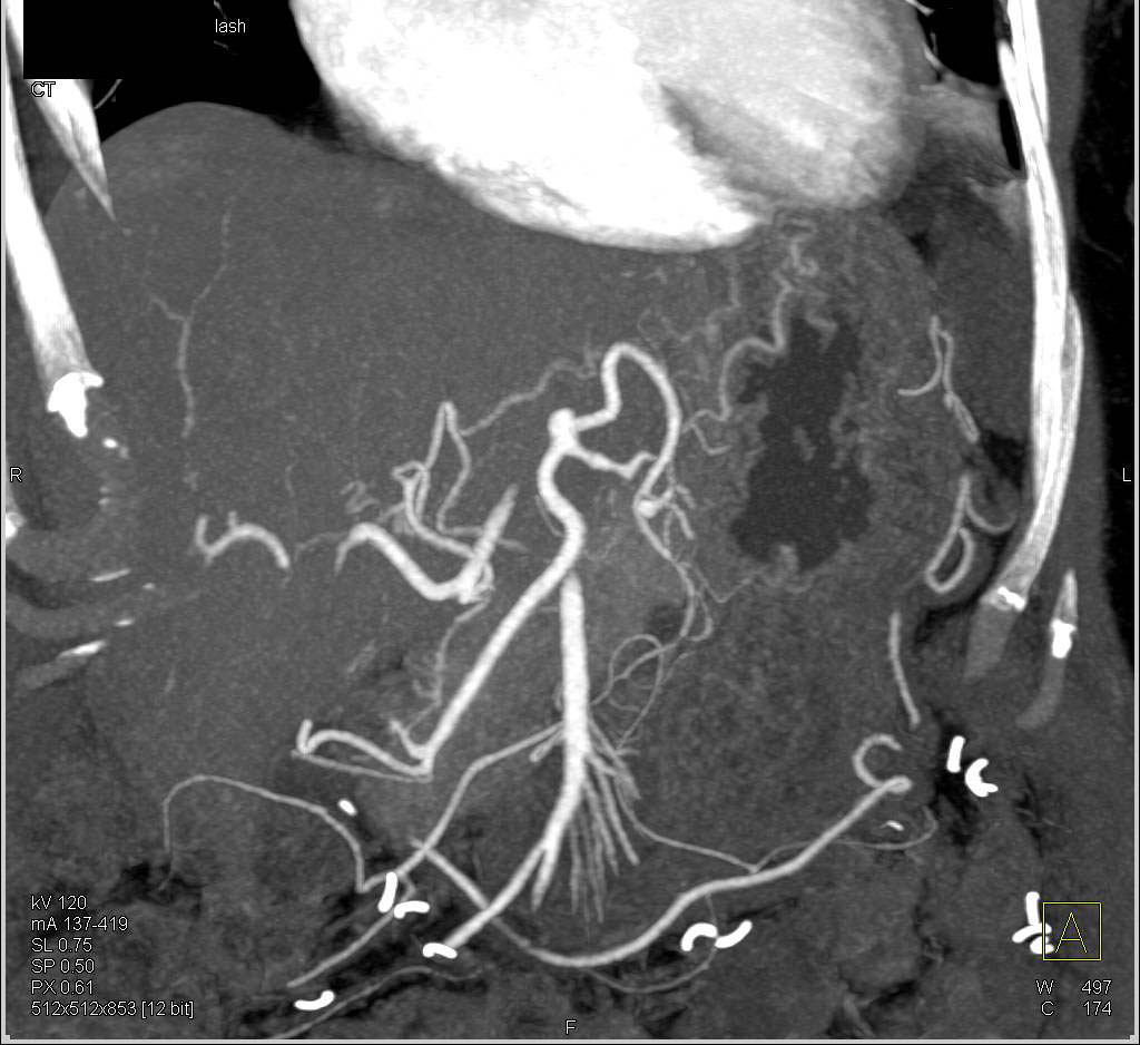 Splenic Infarct - CTisus CT Scan