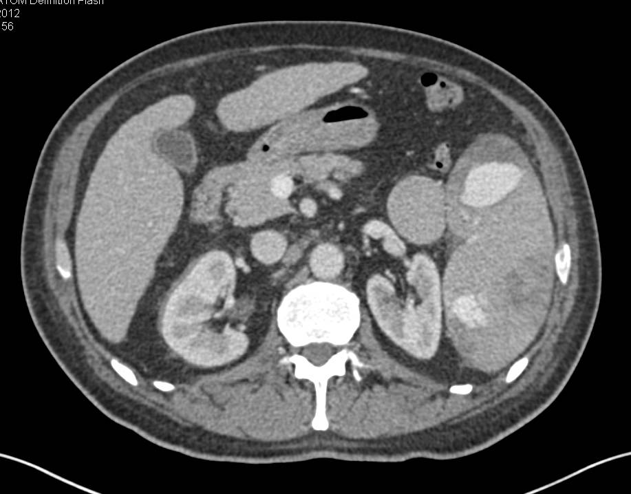 Multiple Zones of Active Bleeding in the Spleen - CTisus CT Scan