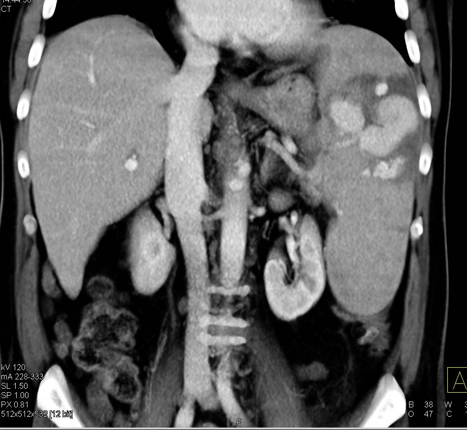 Spontaneous Splenic Bleed Without Trauma - CTisus CT Scan