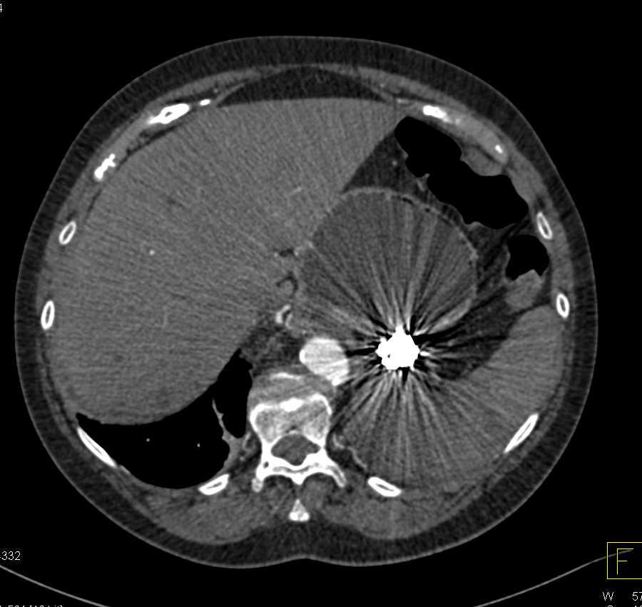 Splenic Infarct s/p Coiling of Splenic Artery Aneurysm - CTisus CT Scan