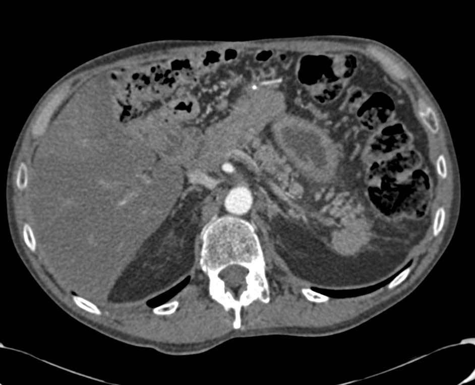 Accessory Spleen Simulates a Pancreatic Mass - CTisus CT Scan