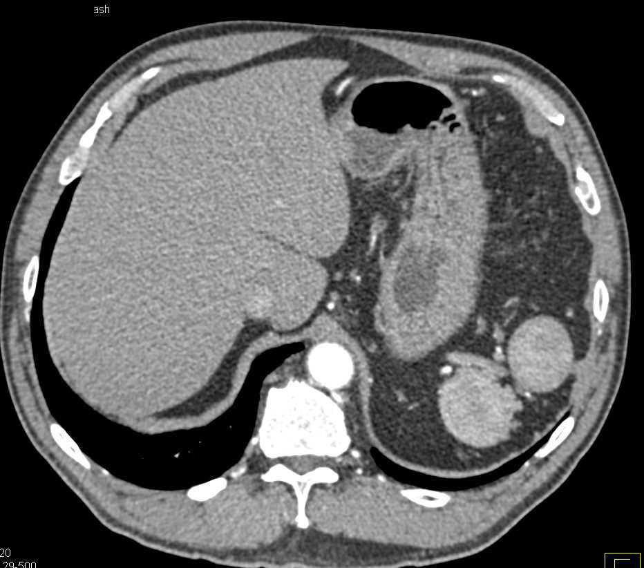 Multiple Splenules in Splenic Bed - CTisus CT Scan