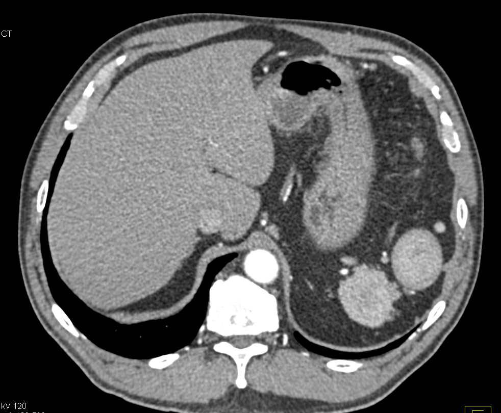 Multiple Splenules in Splenic Bed - CTisus CT Scan