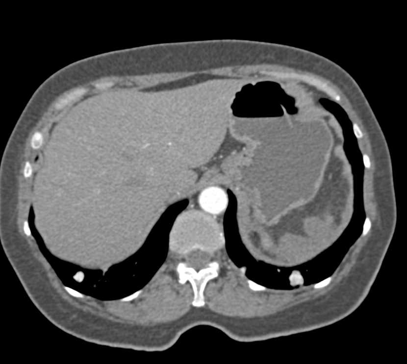 Perisplenic Hematoma Following Left Nephrectomy - CTisus CT Scan