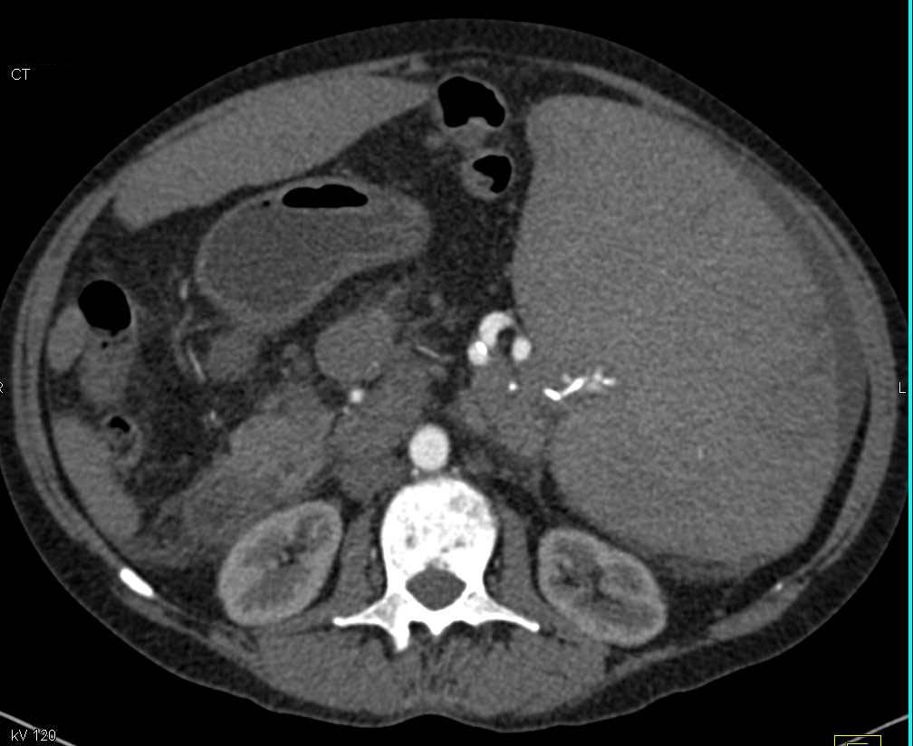 Massive Splenomegaly with Multiple Splenic Infarcts - CTisus CT Scan