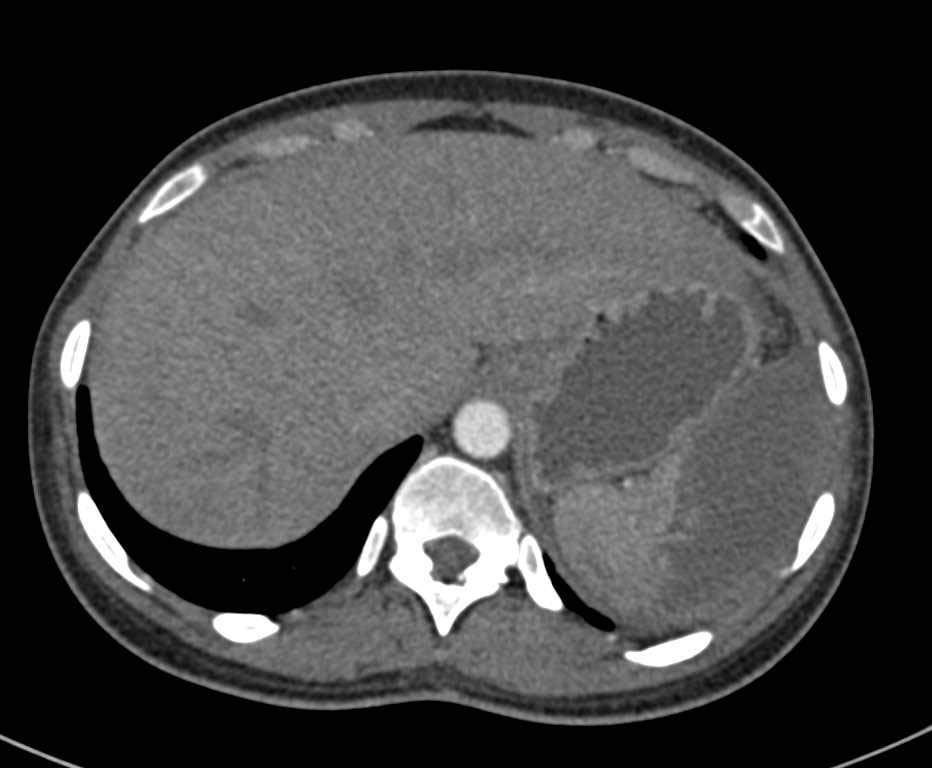 Multiple Splenic Infarcts - CTisus CT Scan