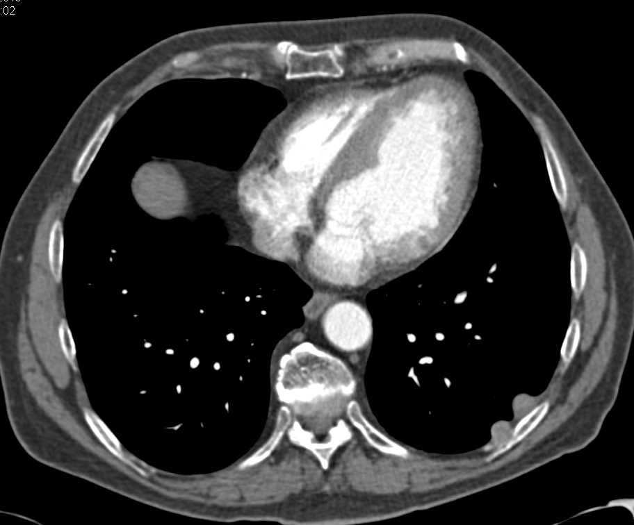 Vascular Metastases to the Spleen in a Patient with Renal Cell Carcinoma - CTisus CT Scan