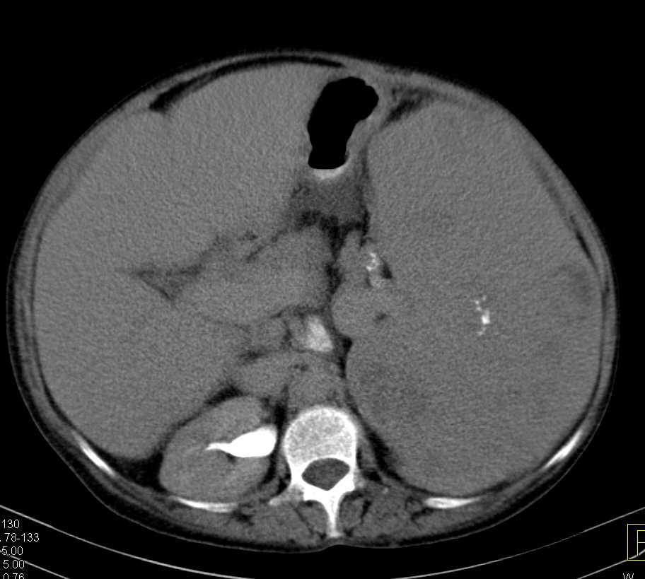 Huge Spleen in Glycogen Storage Disease - CTisus CT Scan