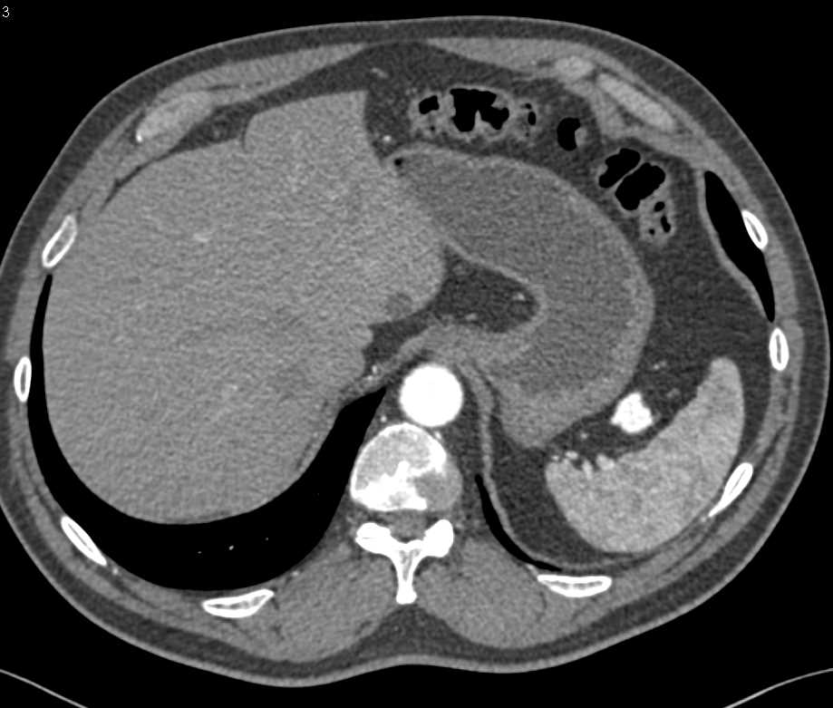 Splenic Artery Aneurysm - CTisus CT Scan