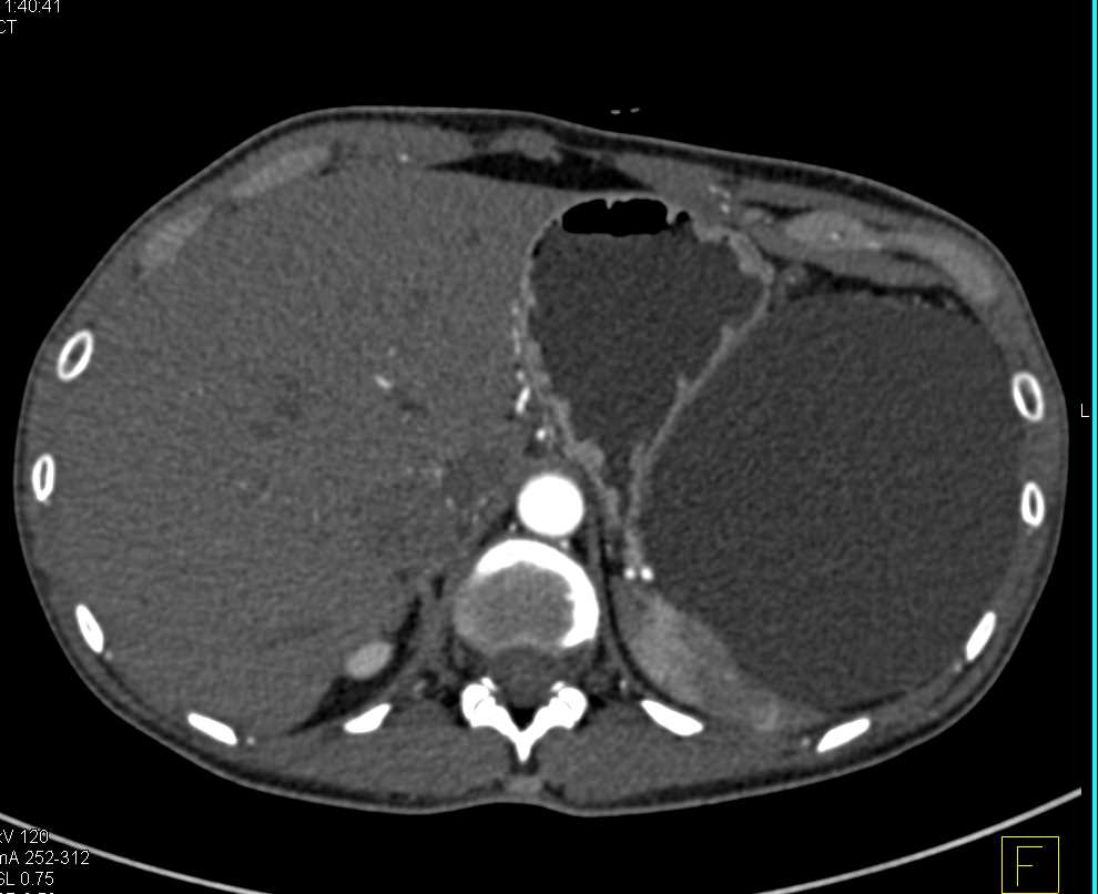 Splenic Cyst - CTisus CT Scan