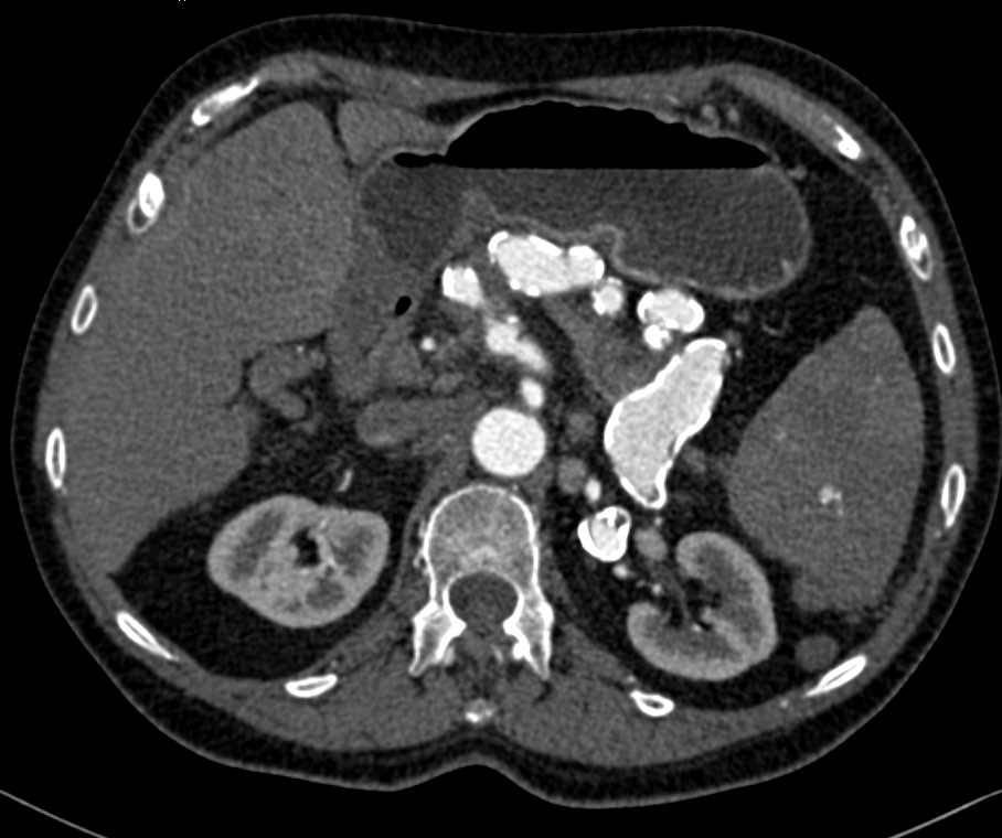 Dilated and Tortuous Splenic Artery with Aneurysms - CTisus CT Scan