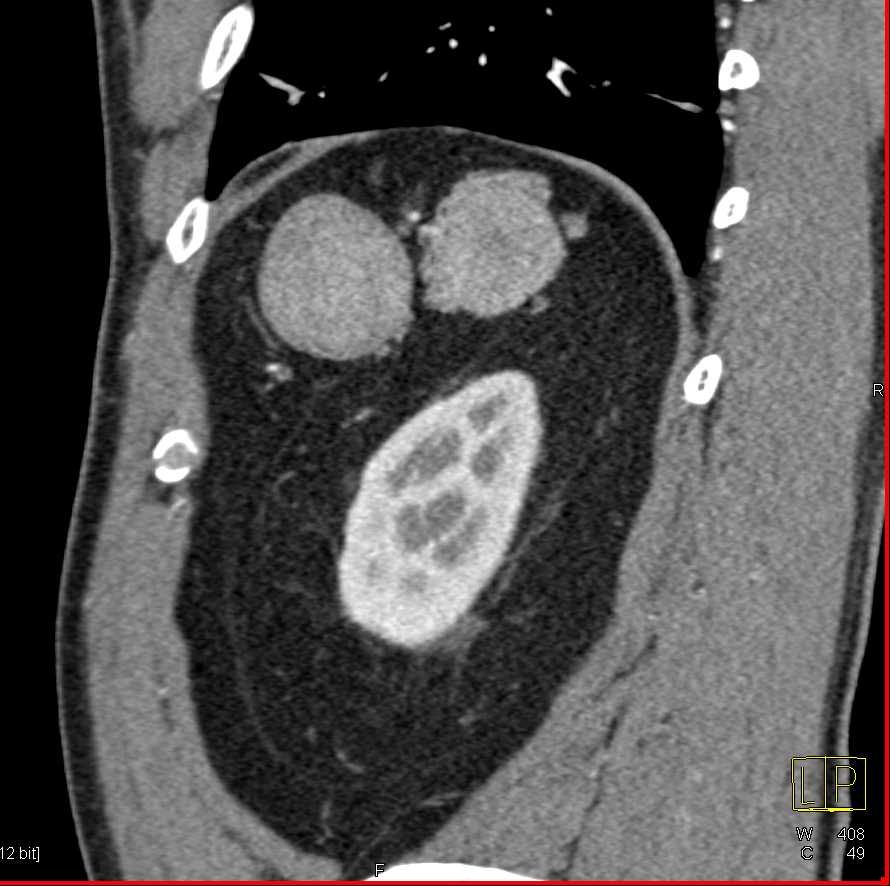 Multiple Accessory Spleens in Patient s/p Splenectomy - CTisus CT Scan