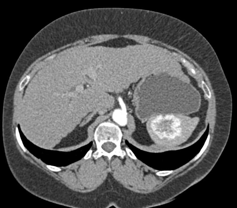 Classic Hemangioma of the Spleen - CTisus CT Scan