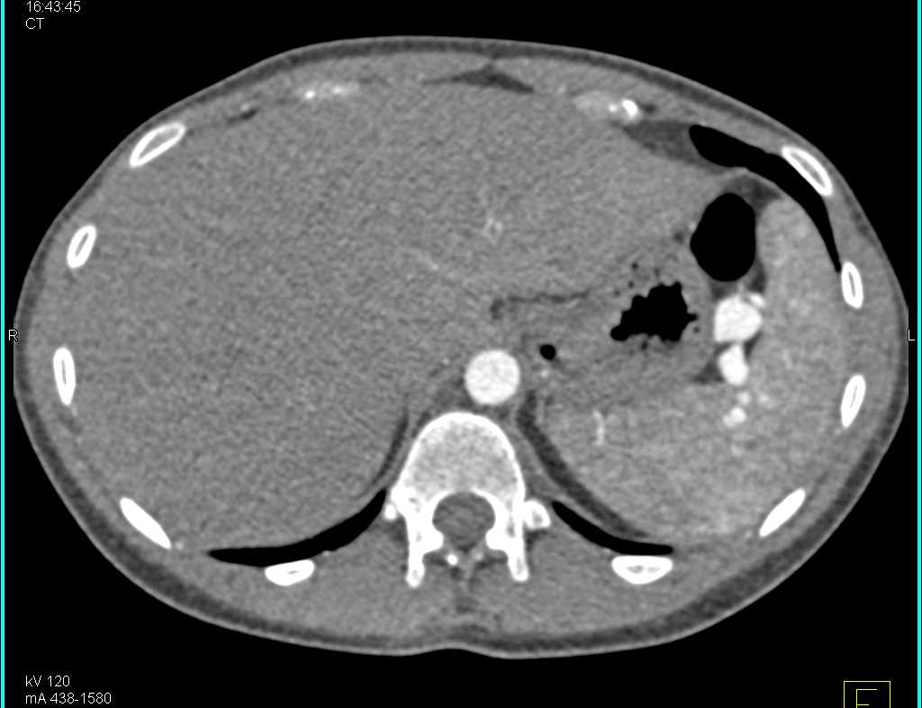 Splenic Artery Aneurysms - CTisus CT Scan