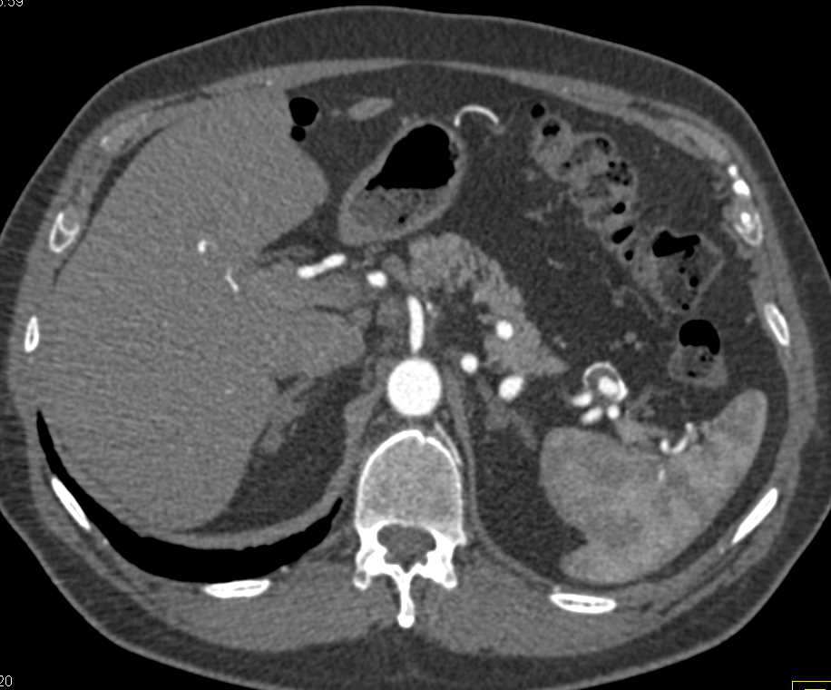 Splenic Artery Aneurysms - CTisus CT Scan