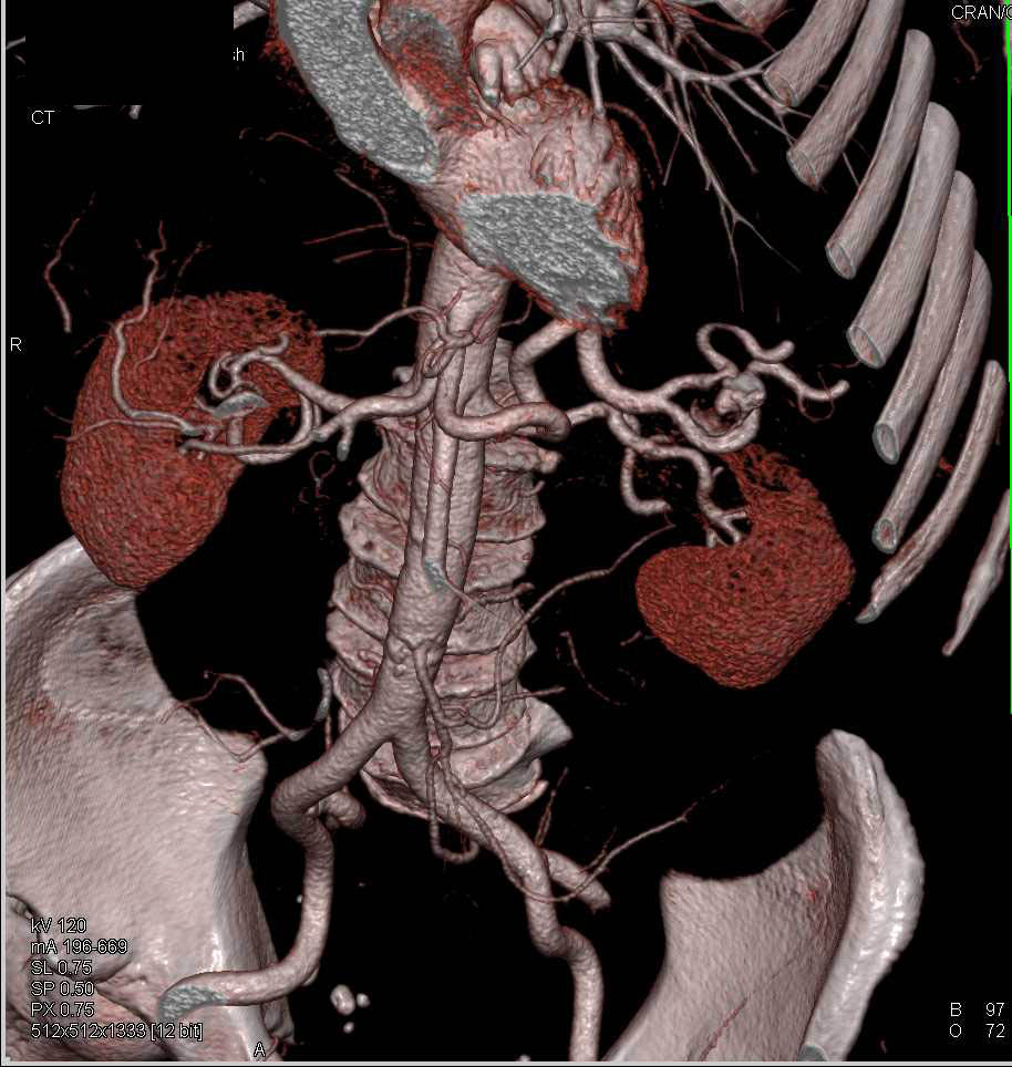 Splenic Artery Aneurysms Spleen Case Studies Ctisus Ct Scanning