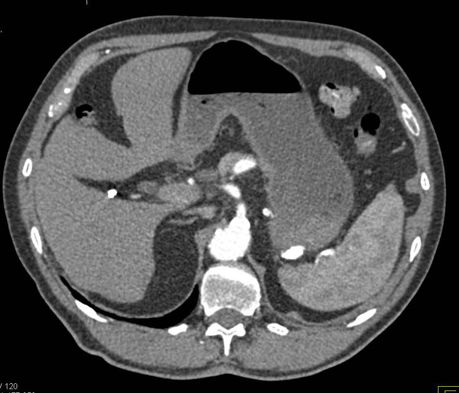 Splenic Artery Aneurysm in a Cirrhotic Patient - CTisus CT Scan