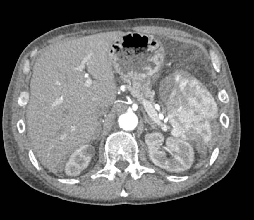 Splenic Laceration with Subcapsular Hematoma and Hemoperitoneum - CTisus CT Scan