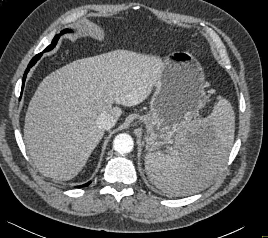 Lymphoma Involves the Spleen, Pancreas and Left Kidney - CTisus CT Scan