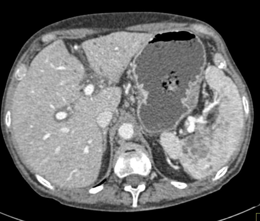 Splenic Hemangiomas - CTisus CT Scan