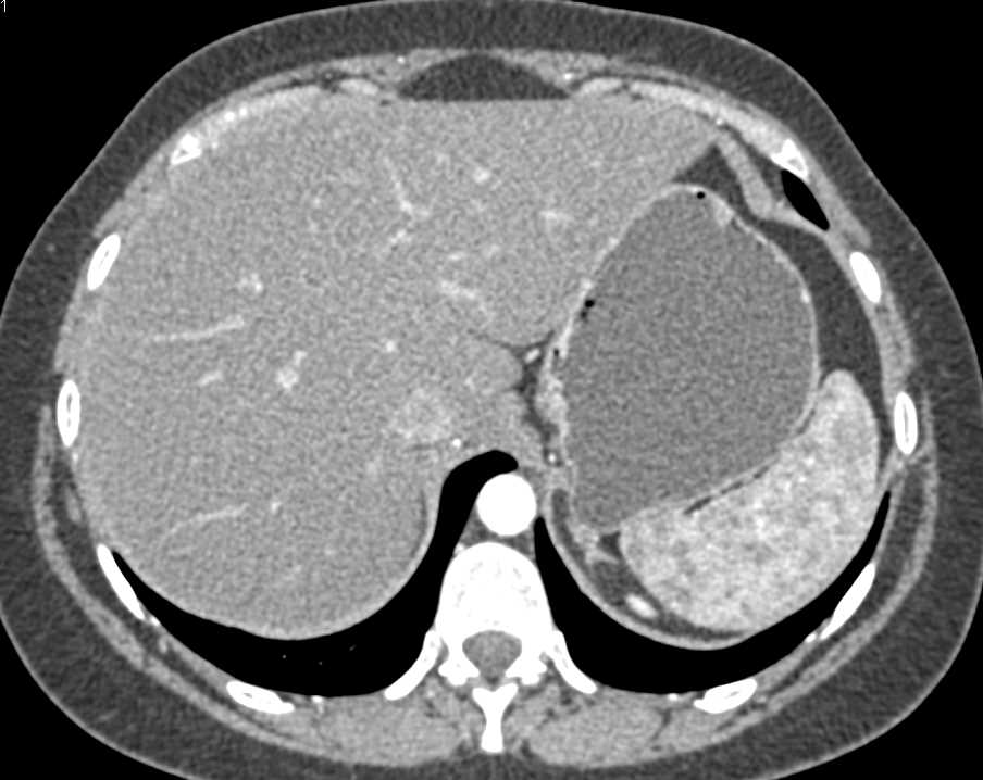 Splenic Lymphoma - CTisus CT Scan