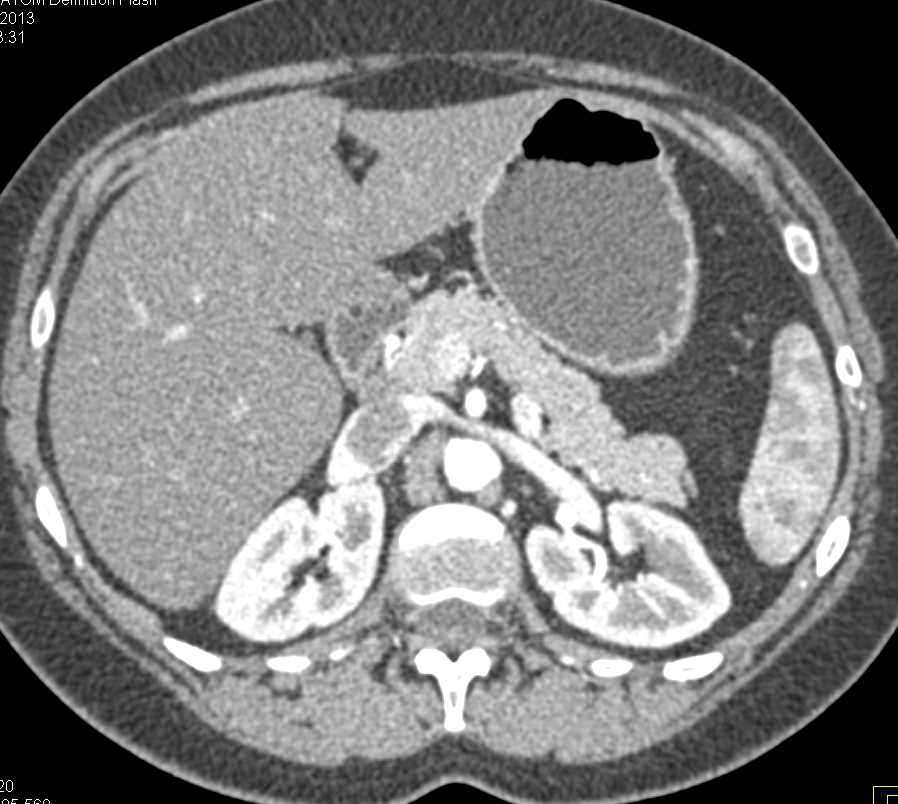 Splenic Lymphoma - CTisus CT Scan