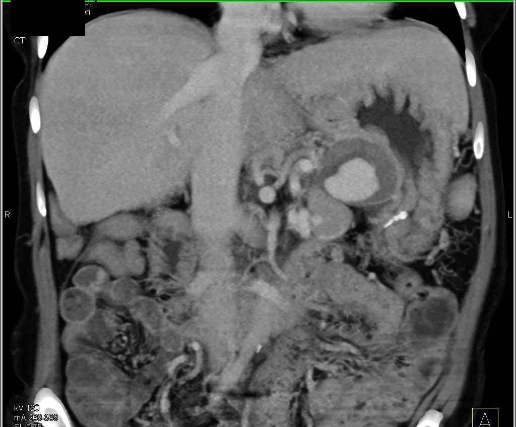 Splenic Artery Pseudoaneurysm - CTisus CT Scan