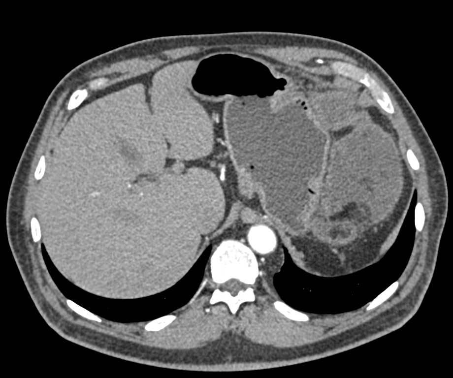 Omental Infarct Left Upper Quadrant Following Splenectomy - CTisus CT Scan