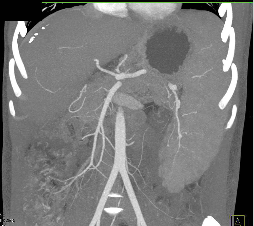 Splenomegaly and Portal Hypertension - CTisus CT Scan