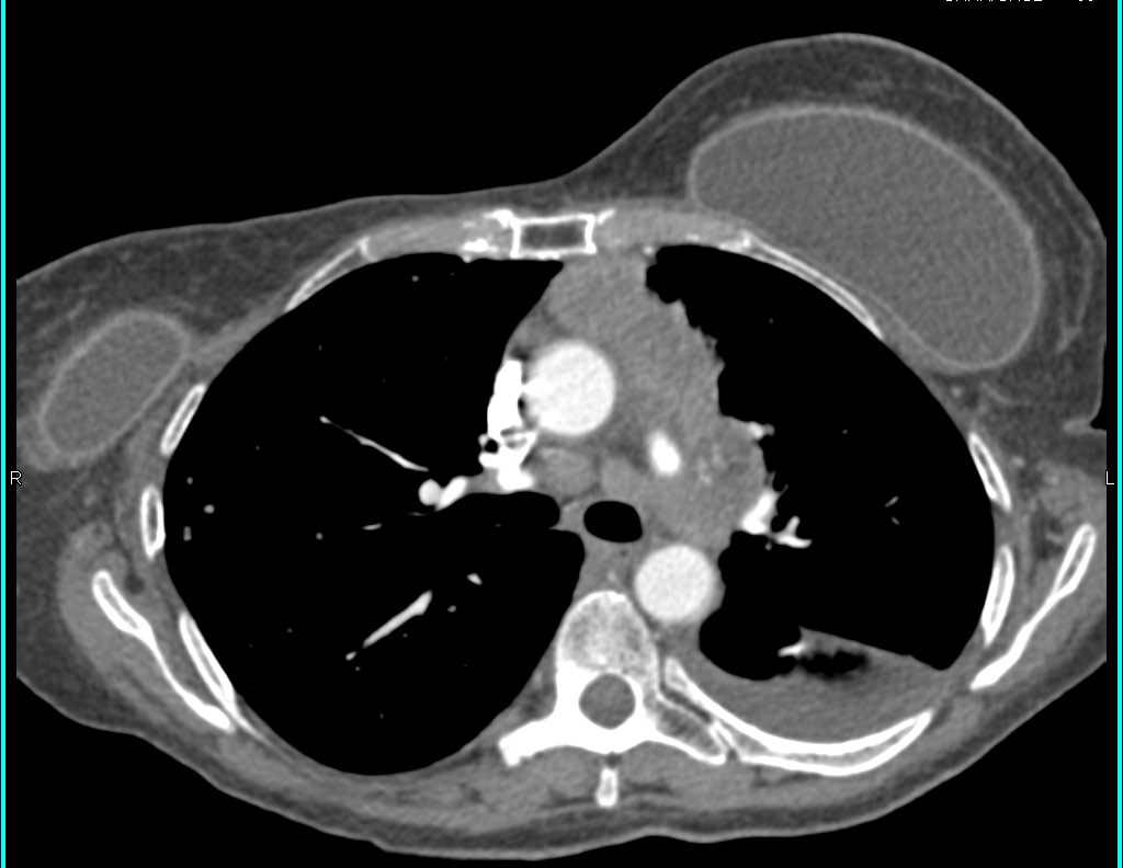 Lymphoma with Splenic Involvement - CTisus CT Scan