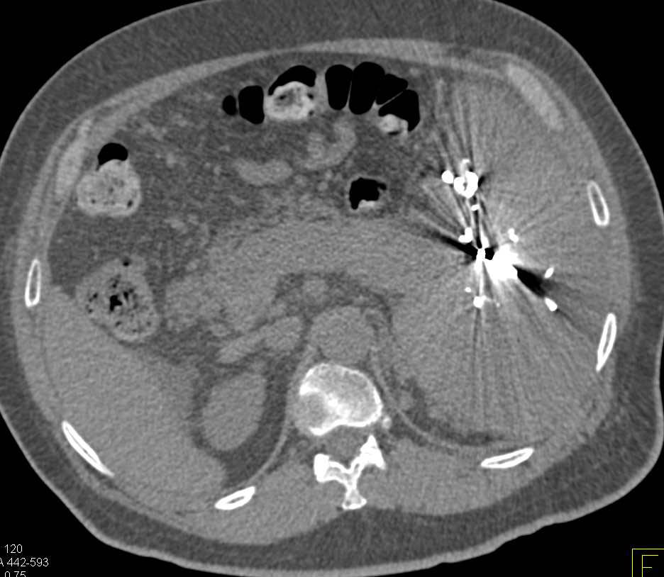 Large Infarction of the Spleen - CTisus CT Scan