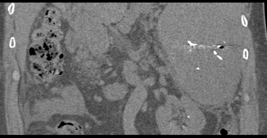 Large Infarction of the Spleen - CTisus CT Scan