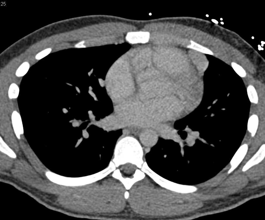 Prior Traumatic Splenectomy with Splenules in Splenic Bed, Pleura, Pericardium and Lung Parenchyma - CTisus CT Scan