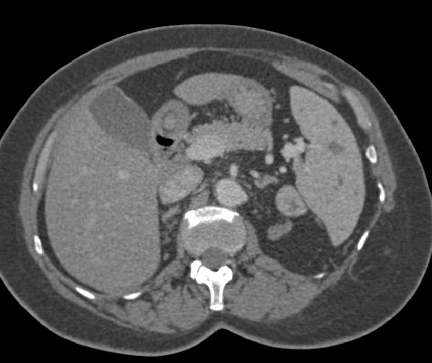 Klippel-Trenaunay-Weber (KTW) Syndrome with Multiple Hemangiomas Including in Spleen - CTisus CT Scan