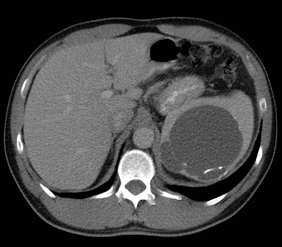 Epidermoid Splenic Cyst - CTisus CT Scan