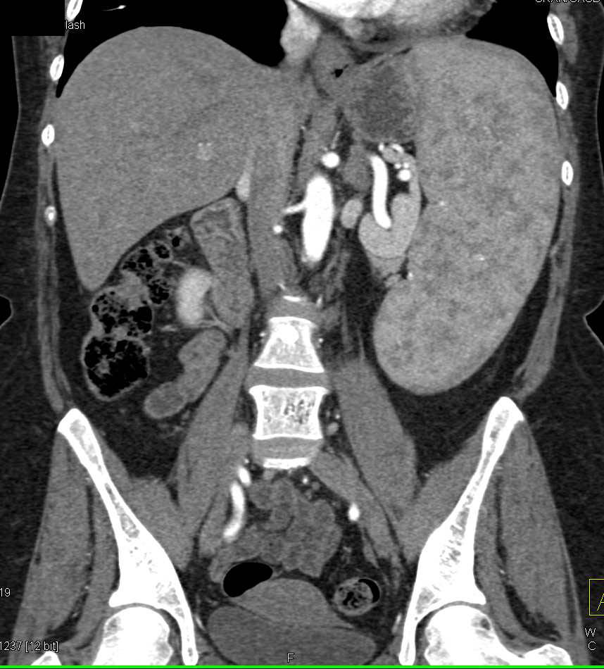 Marked Splenomegaly in a Patient with Myelofibrosis - CTisus CT Scan