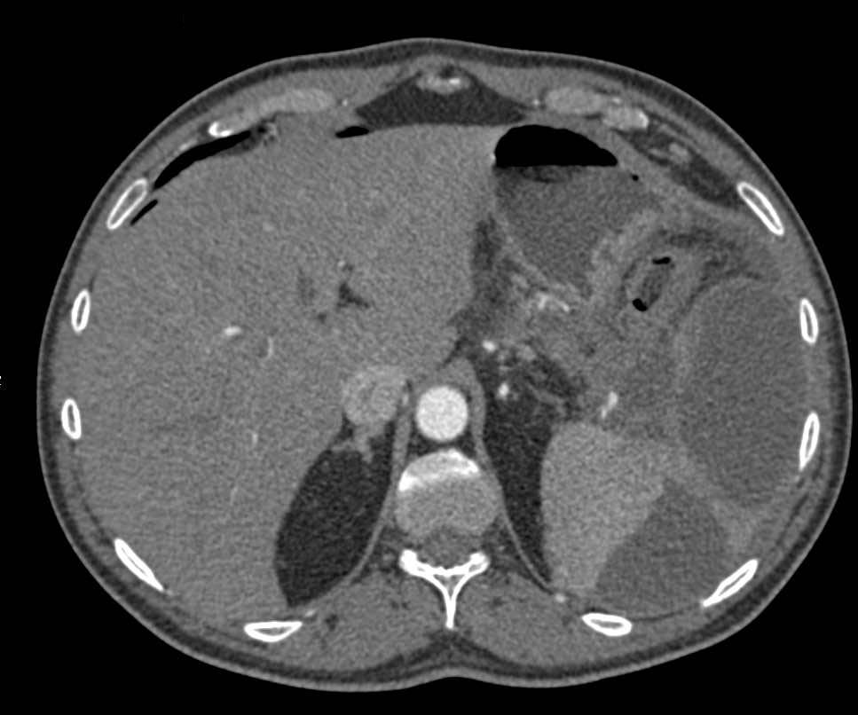 Multiple Splenic Infarcts - CTisus CT Scan