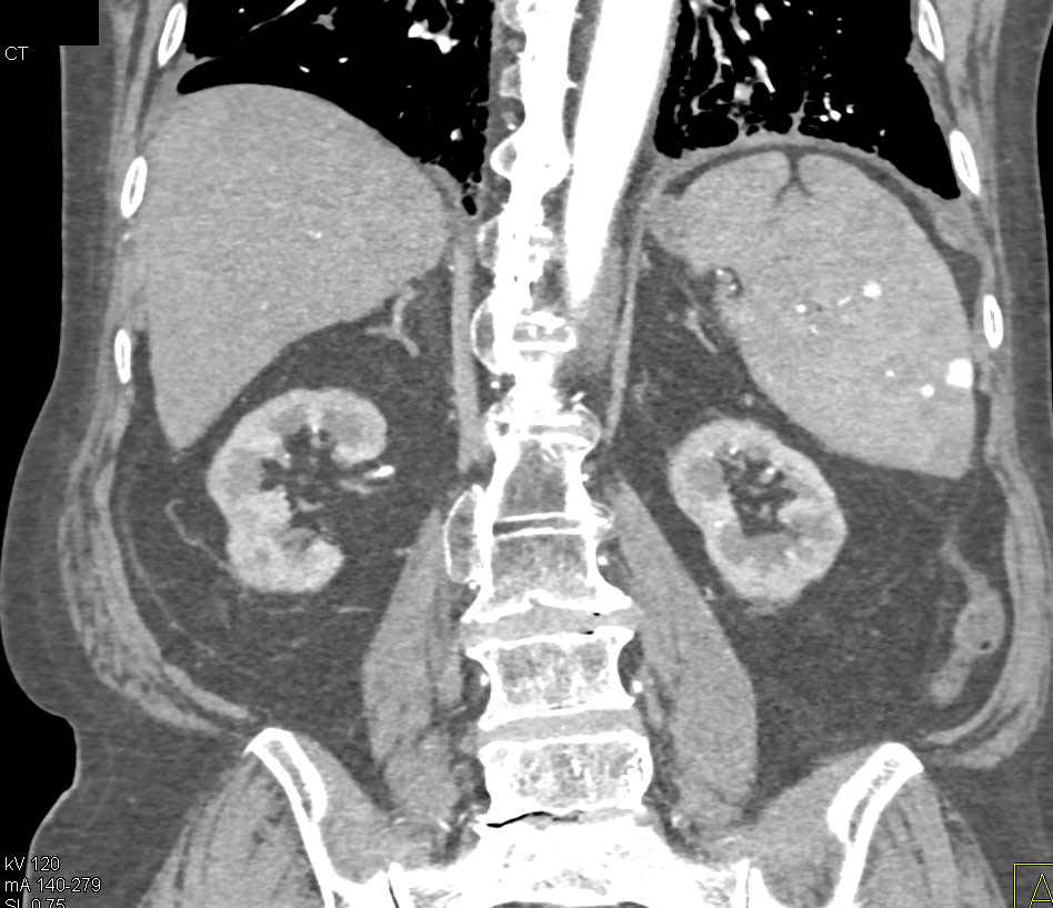 Splenic Hemangiomas - CTisus CT Scan