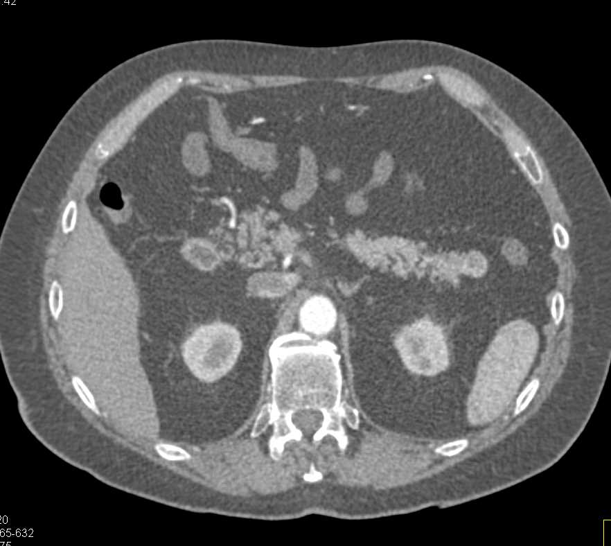 Accessory Spleen Near Tail of the Pancreas - CTisus CT Scan