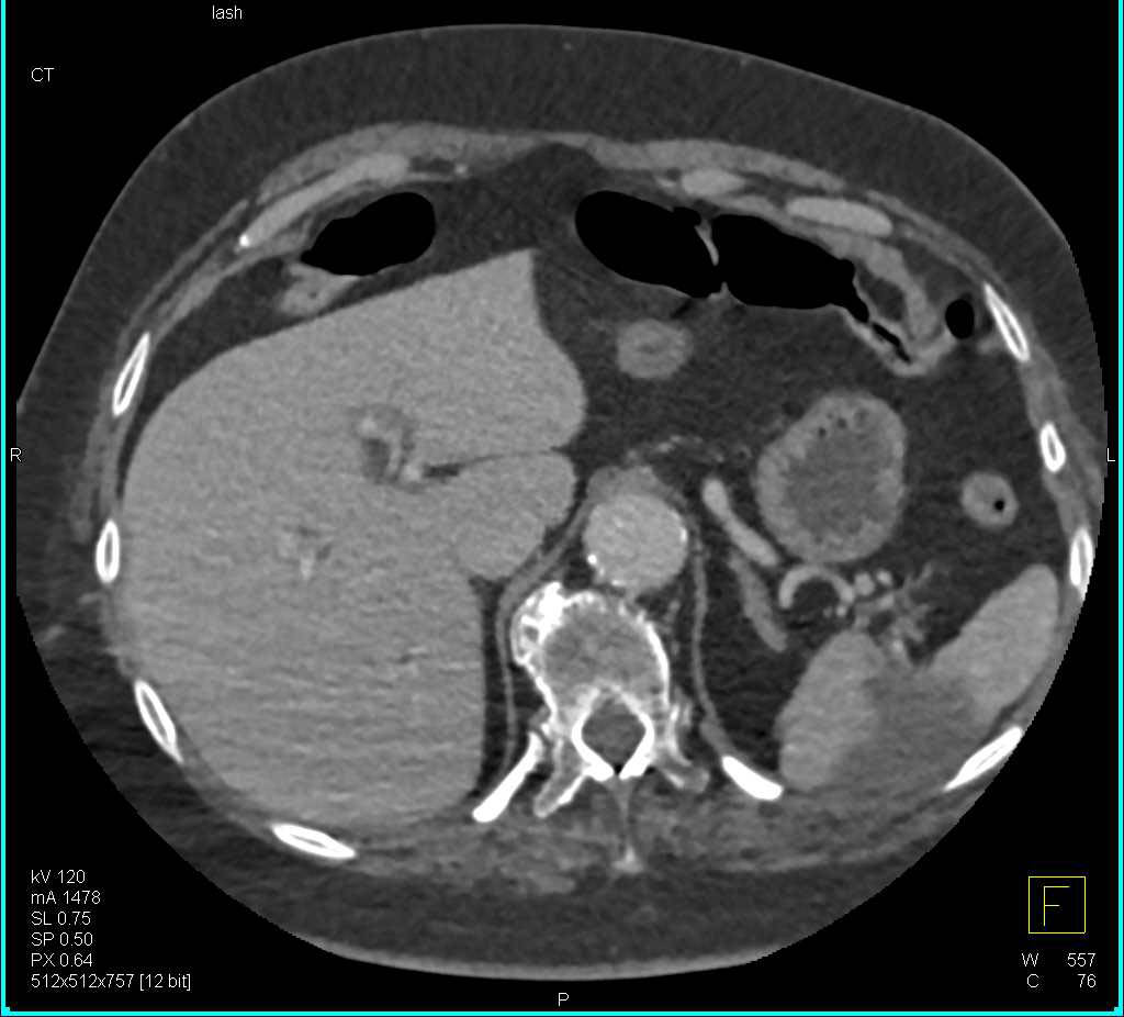 Splenic Infarct - CTisus CT Scan