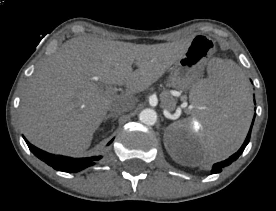 Splenic Hematoma that Has Calcified - CTisus CT Scan