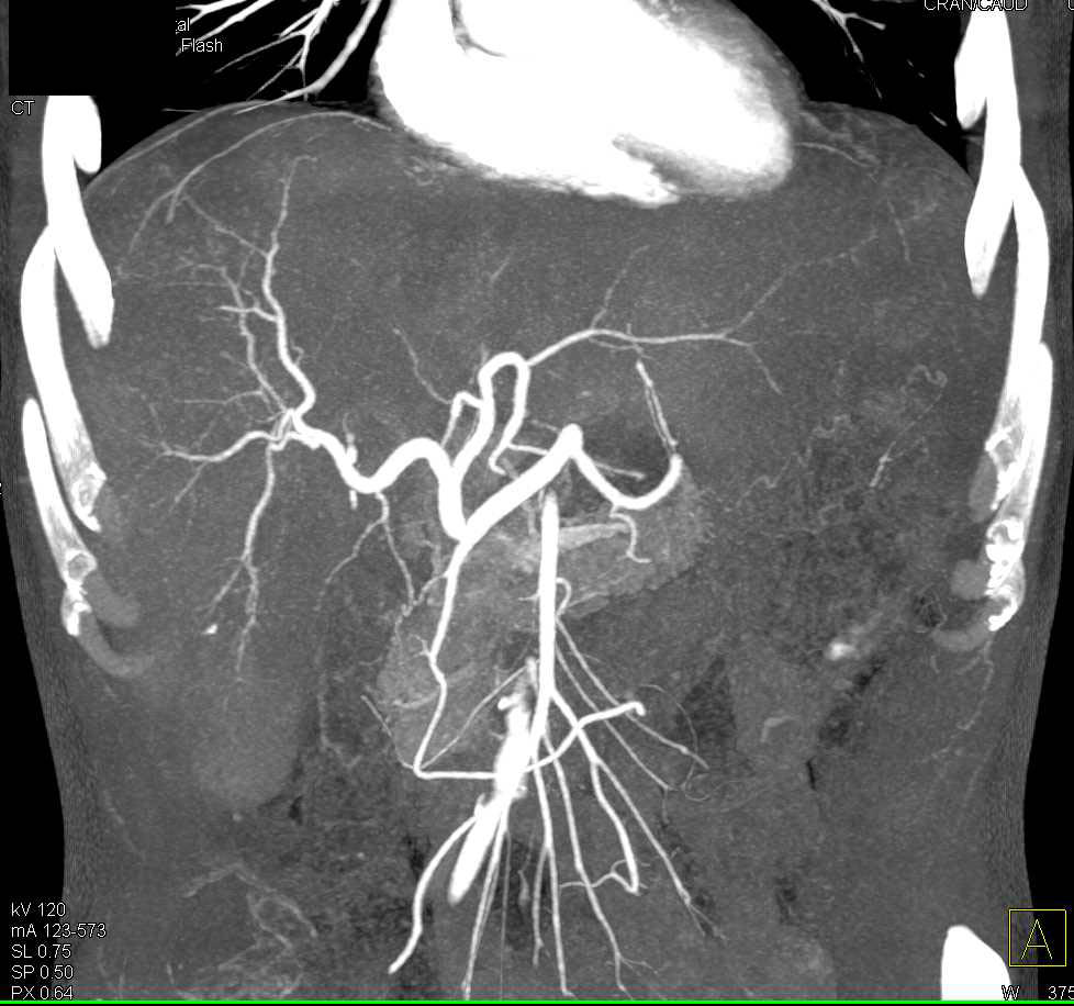 Carcinoma Tail of Pancreas Invades the Spleen with Infarction and Liver Metastases - CTisus CT Scan