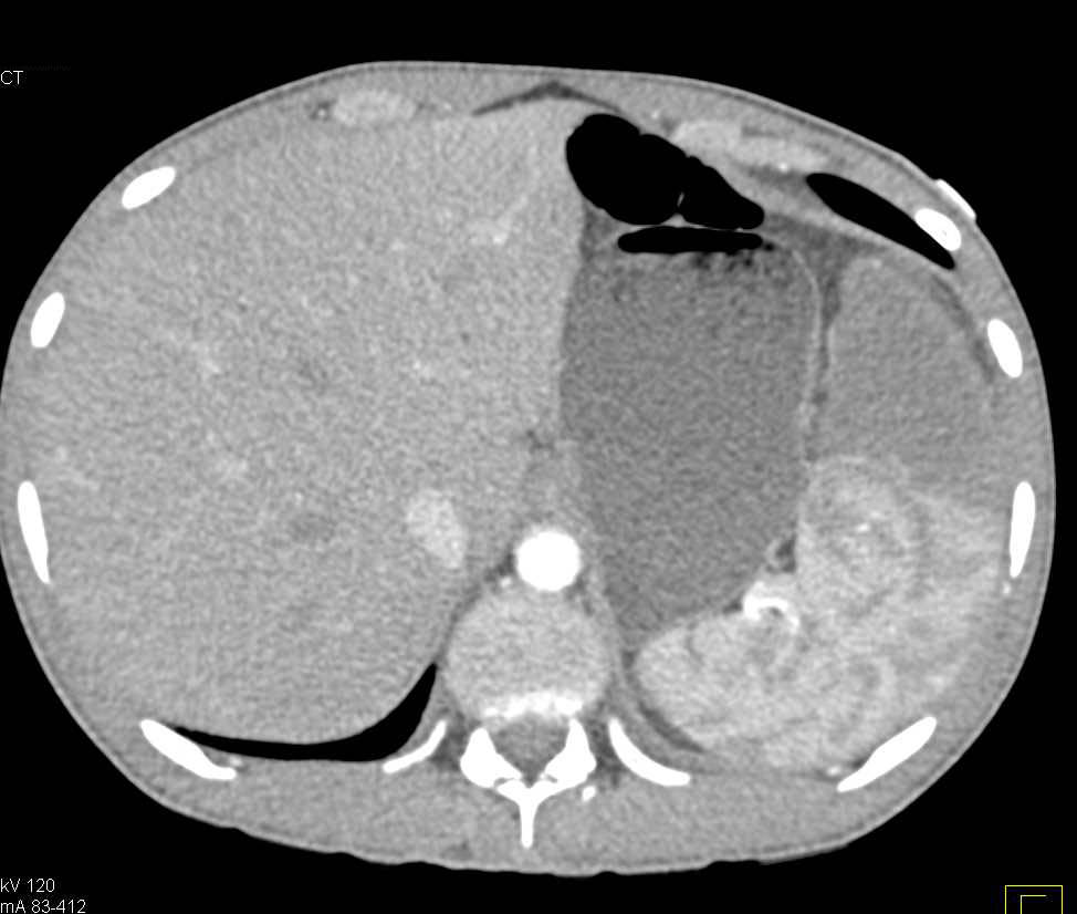 Large Splenic Infarction - CTisus CT Scan