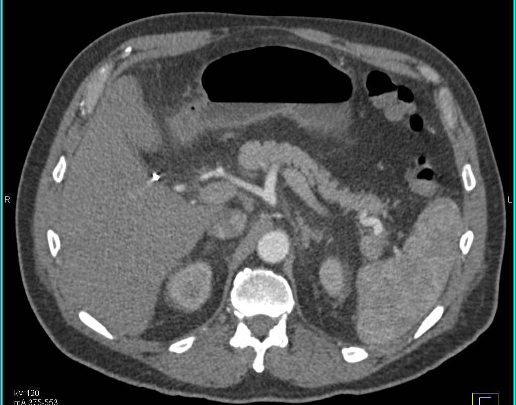 Splenule Simulates a Tail of Pancreas Mass - CTisus CT Scan