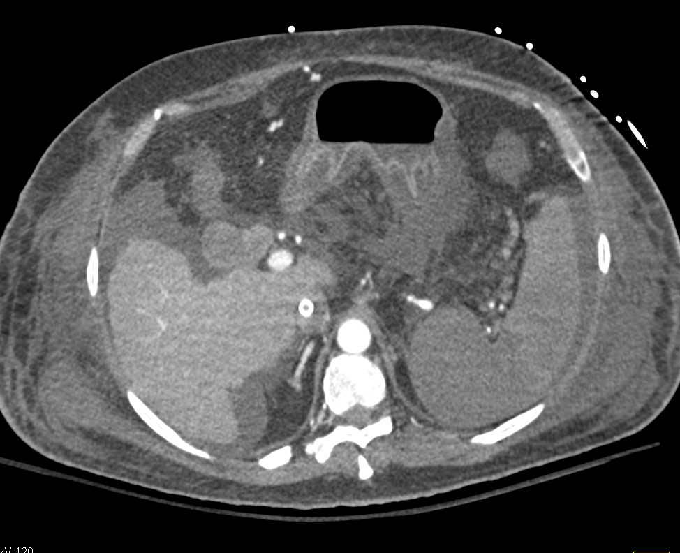 Multiple Splenic Infarcts in a Cirrhotic Patient - CTisus CT Scan