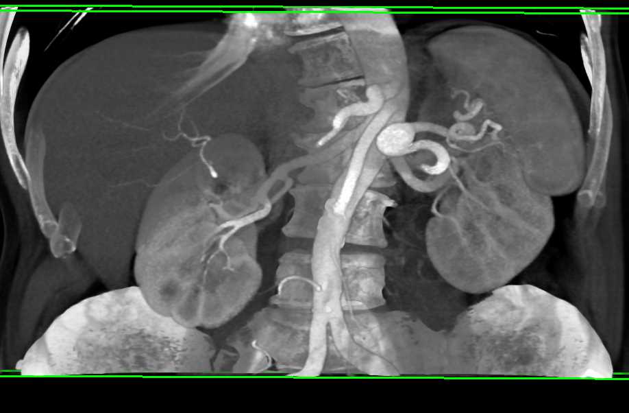 Splenic Artery Aneurysm - CTisus CT Scan