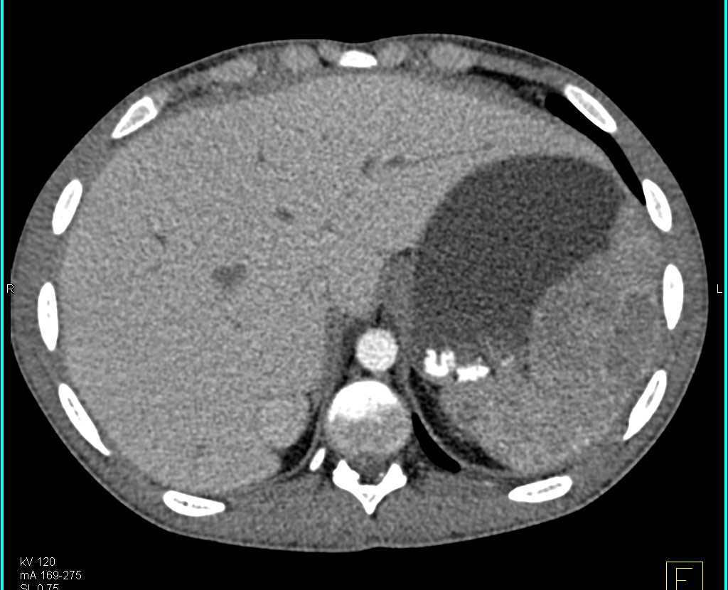 Splenic Lymphoma Which is Subtle at Select Phases - CTisus CT Scan