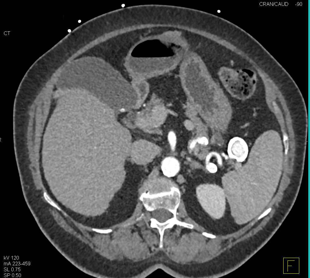 Splenic Artery and Renal Artery Aneurysms - CTisus CT Scan