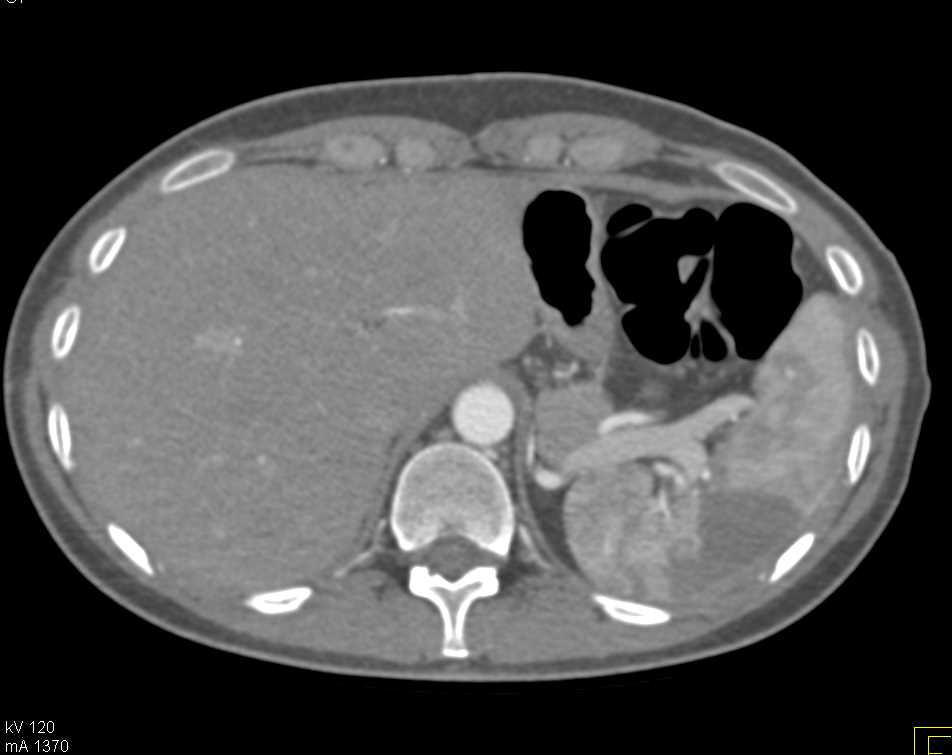 Splenic Infarct - CTisus CT Scan