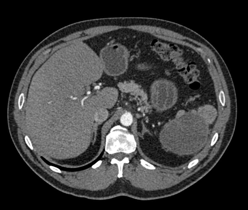 Cystic Lesion by Spleen - CTisus CT Scan